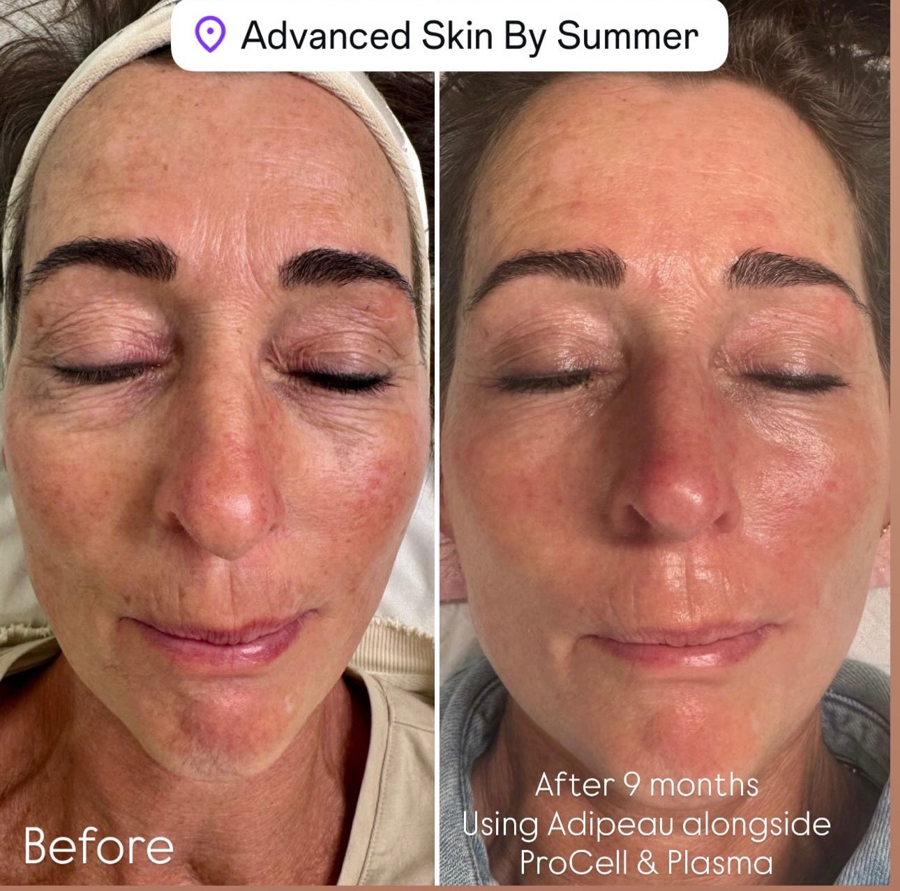 ProCell MD Step 1 & 2 Serums Cellar Renewal + Healing Accelerator