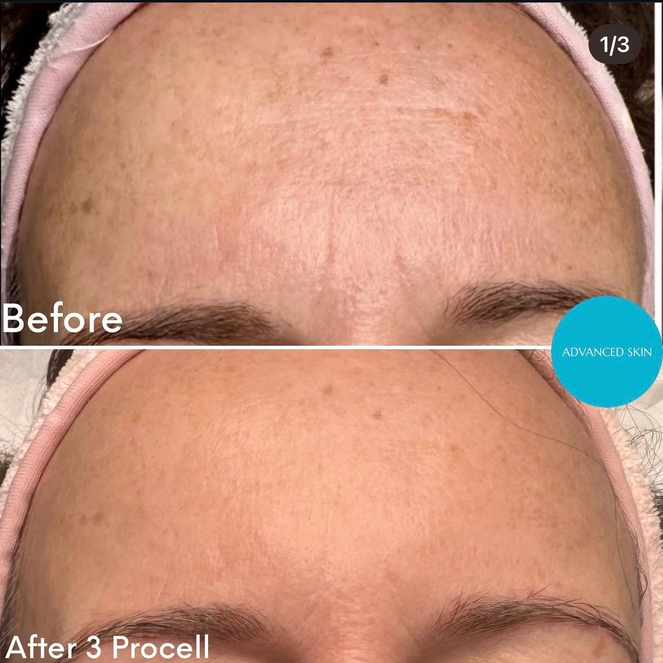ProCell MD Step 1 & 2 Serums Cellar Renewal + Healing Accelerator