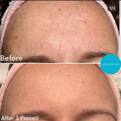 ProCell MD Step 1 & 2 Serums Cellar Renewal + Healing Accelerator