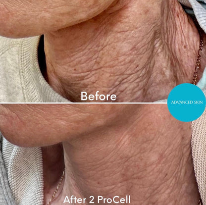 ProCell MD Step 1 & 2 Serums Cellar Renewal + Healing Accelerator