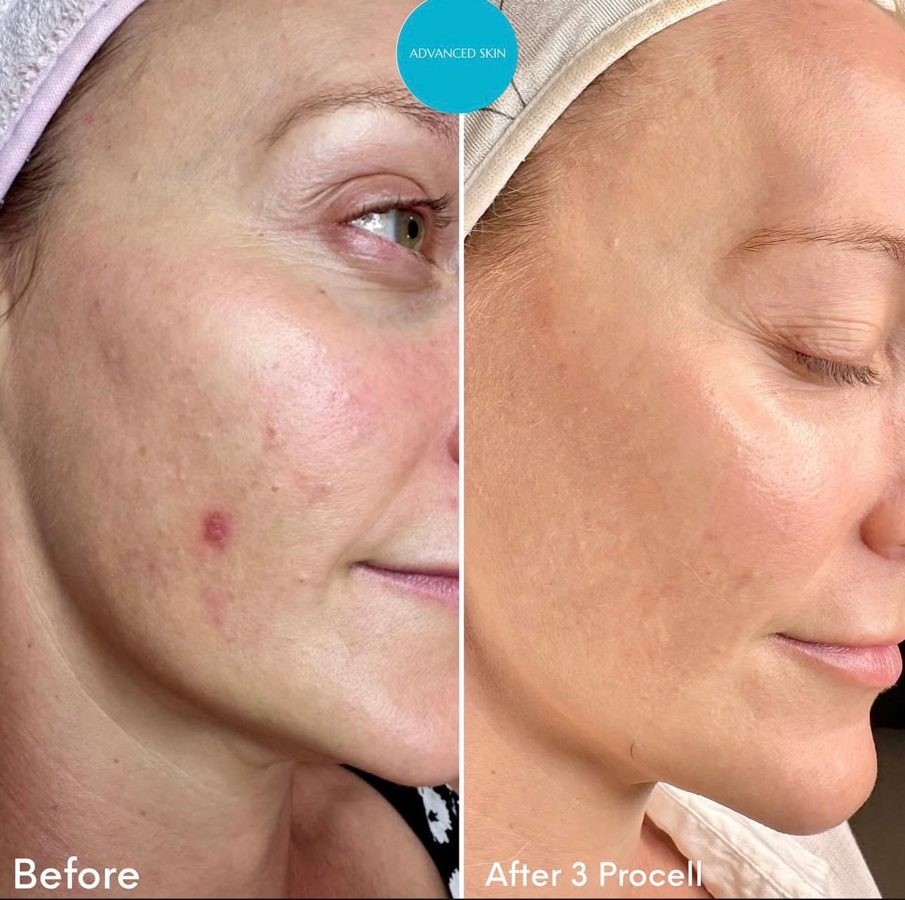 ProCell MD Step 1 & 2 Serums Cellar Renewal + Healing Accelerator