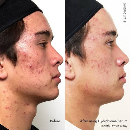 Hydrobiome Serum (Targets Acne)