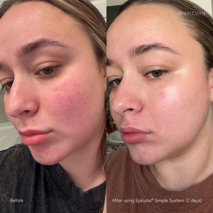 Hydrobiome Serum (Targets Acne)
